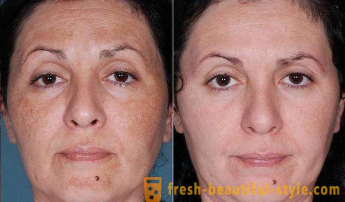 Acid peels sejai: atsauksmes, fotogrāfijas pirms un pēc