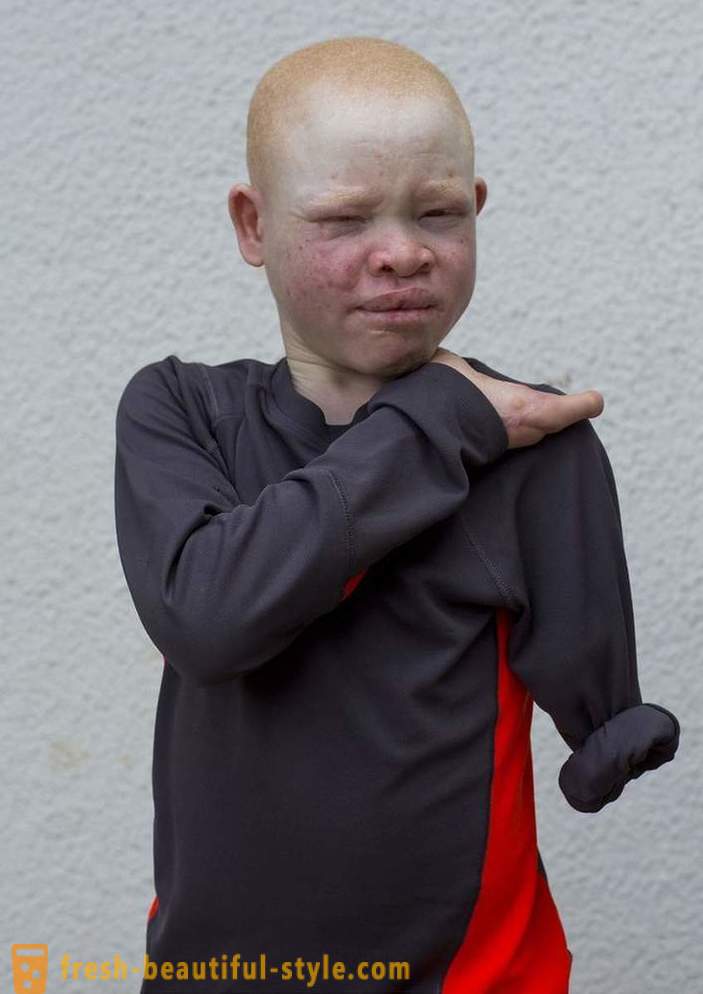 Traģiskais vēsture Tanzānijas albīnu