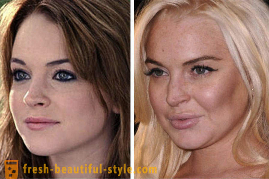15 slavenības, gatavo slikti ar Botox