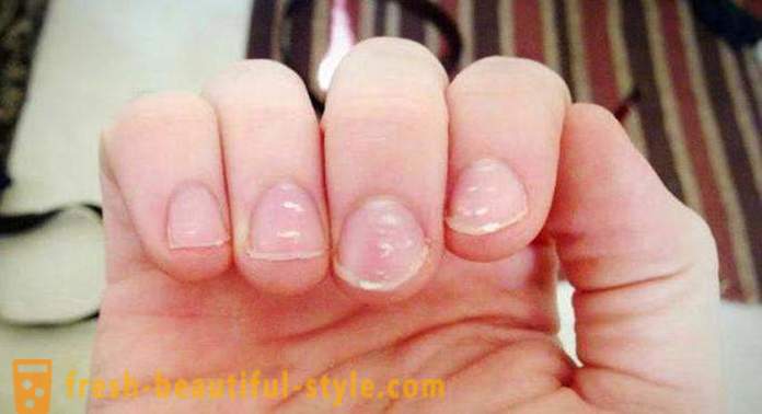Balti plankumi uz nagiem pirkstiem: cēloņi un ārstēšana