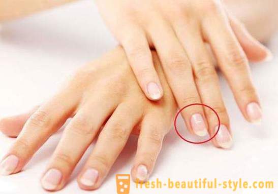 Balti plankumi uz nagiem pirkstiem: cēloņi un ārstēšana