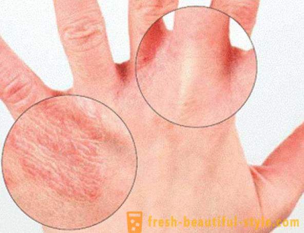Sausa āda roku: cēloņi. Ļoti sausa āda, ko darīt?