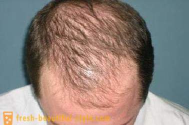 Kā paātrināt matu augšanu uz galvas? Restaurācija matu augšanu