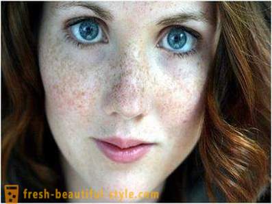 Rūpēties par savu skaistumu un jaunību: izraisa pigmentāciju uz sejas